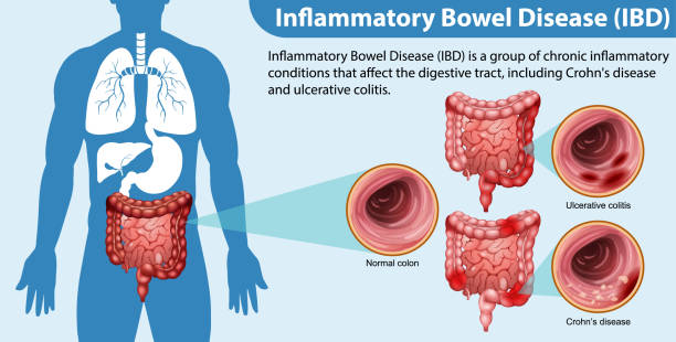 Best IBD treatment doctor in Parel